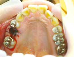 >自家歯牙移植症例01治療前